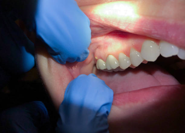 Best Emergency Tooth Extraction in Wilson, PA